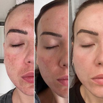 Unveiling Radiance: A Journey of Melasma Transformation with PCA SKIN Professional Ultra Peels