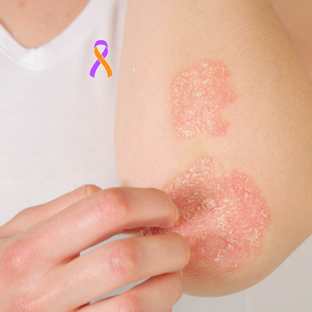 Understanding Psoriasis: More Than Skin Deep