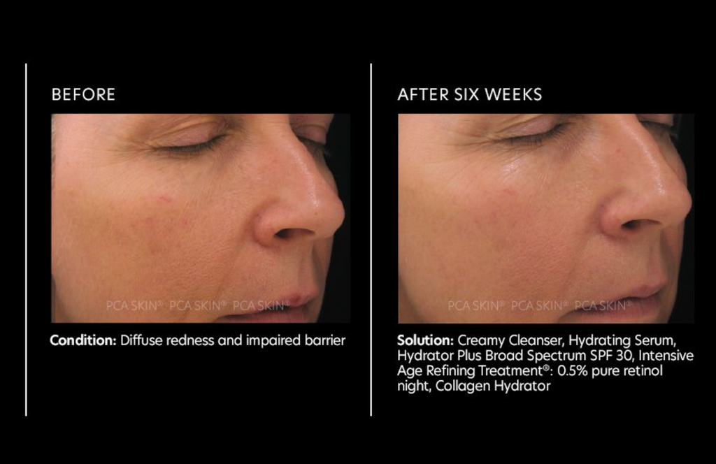Intensive Age Refining Treatment®: 0.5% pure retinol night