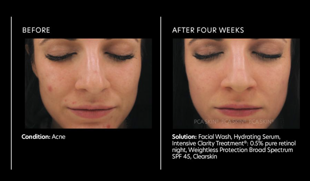 Intensive Clarity Treatment®: 0.5% pure retinol night