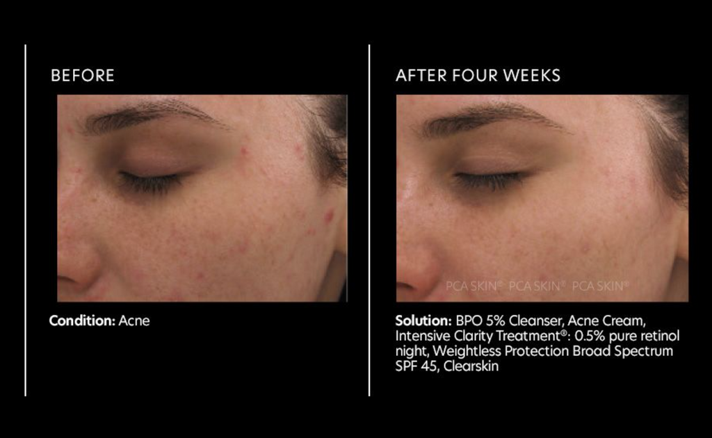 Intensive Clarity Treatment®: 0.5% pure retinol night