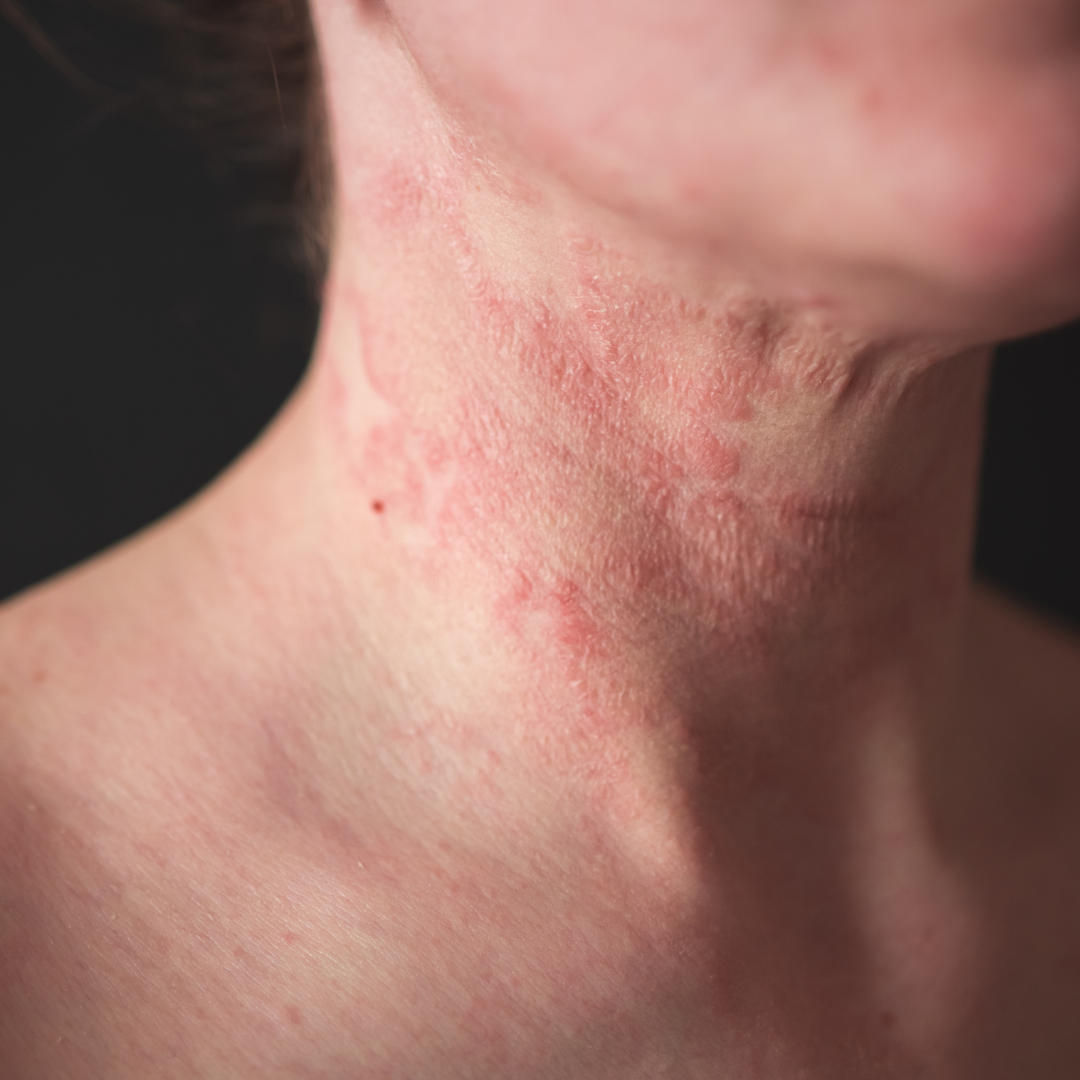 Understanding Eczema and its solutions