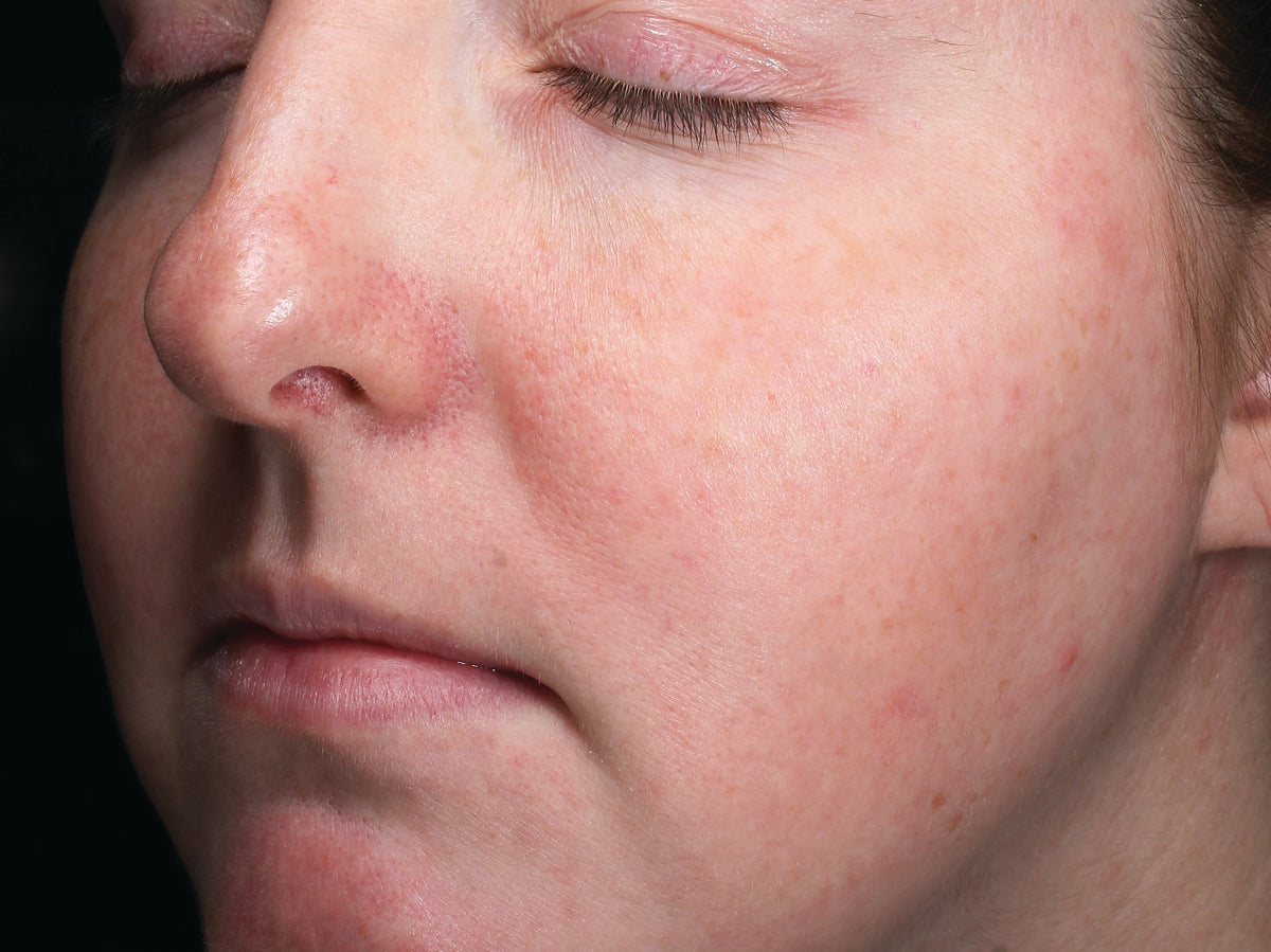 Calm, Balanced Skin: Understanding Advanced OmniSome Technology