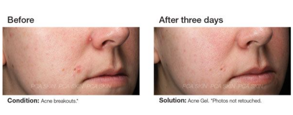 Acne Gel Advanced Treatment