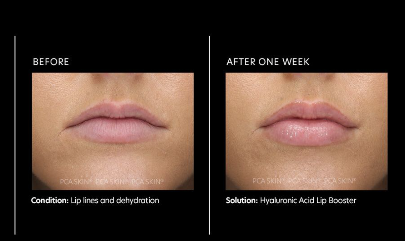 Hyaluronic Acid Lip Booster